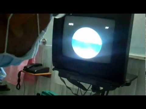 Snoring Singer for Throat Surgery