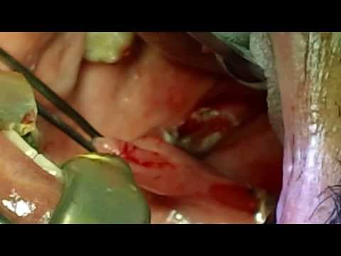 Snoring Sleep Apnea:Surgical Option in India