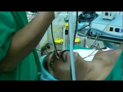 Snoring:Sleep Surgery:Dynamic Endoscopy