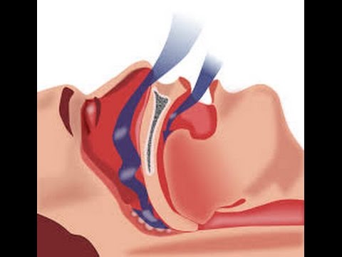 Snoring Surgery-Does It Really Work?