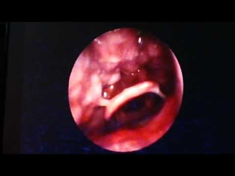 Snoring Treatment-CPAP or Surgery? First Do Sleep Endoscpy