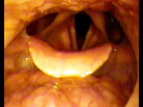 Snoring Treatment:DISE-1Year After OSA Surgery