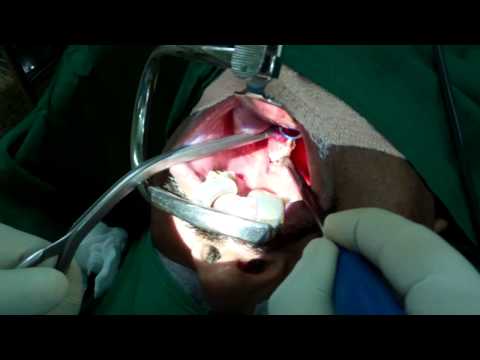 Snoring Treatment in Trivandrum India