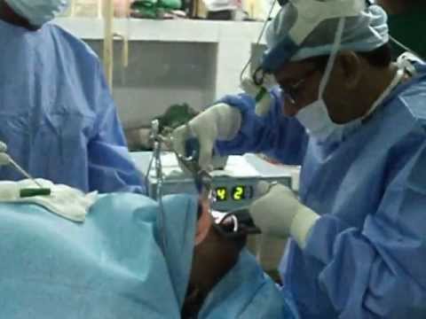 Soft Palate Channeling in Snoring.AVI