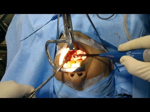 Soft Palate Surgery in Sleep Apnea