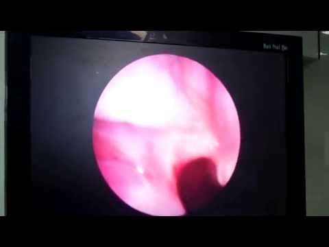 Spitting Blood- Is it from Nose?