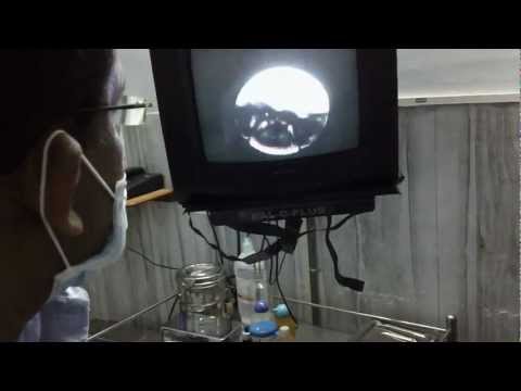 Sr.Mareena is having Vocal nodule