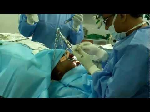 Surgery for Snoring and OSA:Nasal Turbinoplasty