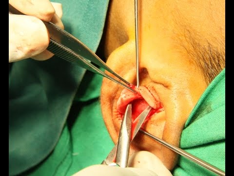 Taking Ear ( Conchal) Cartilage Graft For Rhinoplasty