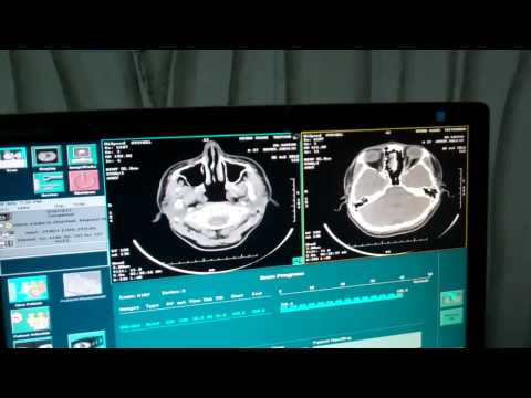 TB of Nasopharynx Treated:Follow up CT Imaging