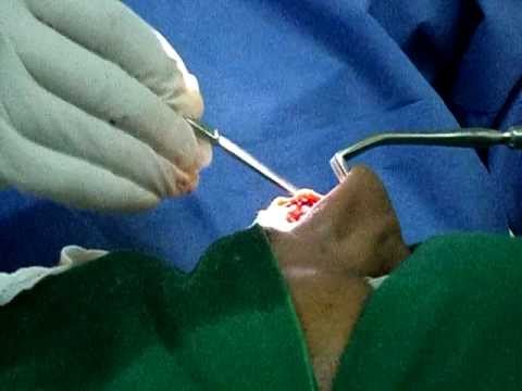 The Indian Rhinoplasty