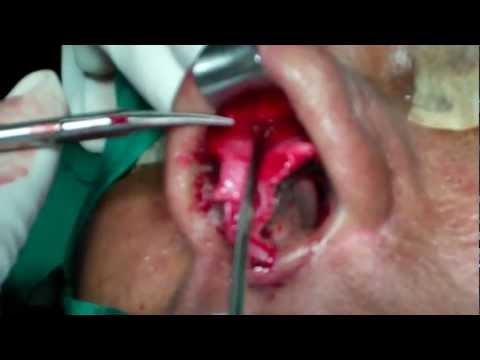 Thick Skin Rhinoplasty in India