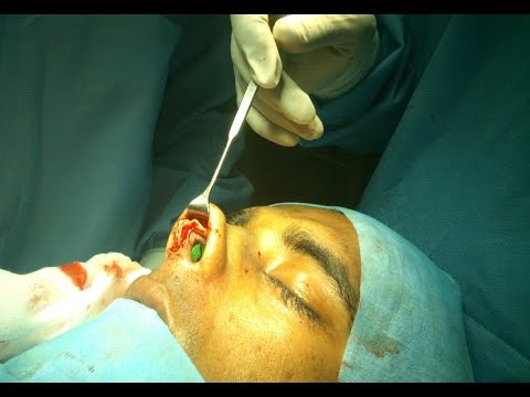 To get a good looking Nose-Rhinoplasty