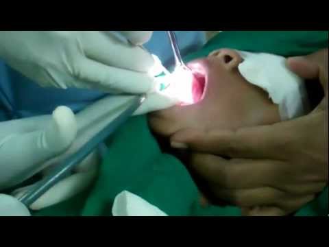 Tongue Release By Laser:The Easiest Way