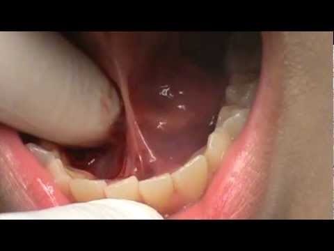 Tongue Tie and Speech Defect in Children-Treatment