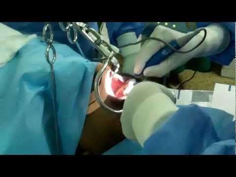 Tonsil Channeling for Snoring and OSA