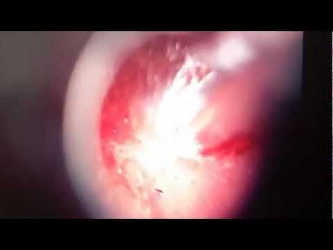 Treating Airplane Ear (Barotraumatic Otitis)