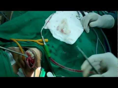 Treating Fungal Sinusitis in India