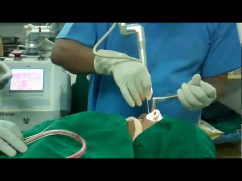 Treating Record Sneezer with Laser