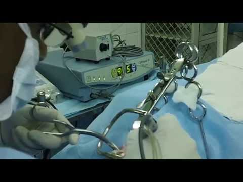 Treatment of Snoring and Sleep Apnea