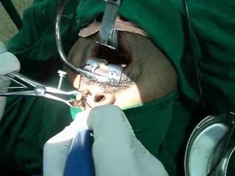 Turbinate reduction to cure snoring and OSA