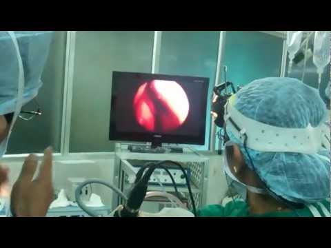 Turbinate Surgery Over View:Using Microdebrider