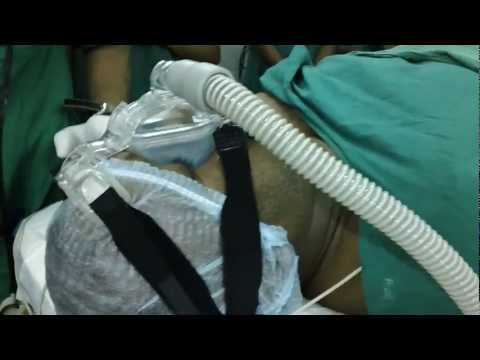 Unable to tolerate CPAP : What else can be done?