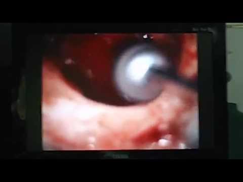 Very Large Cholesteatoma of the Ear Causing Facial Palsy