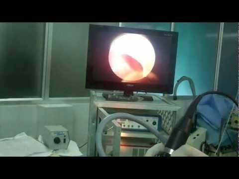 Video Endoscopy of Nose Live