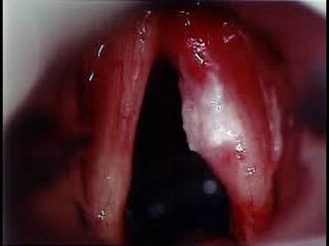 Vocal Cord Surgery-Endolaryngeal Microsurgery