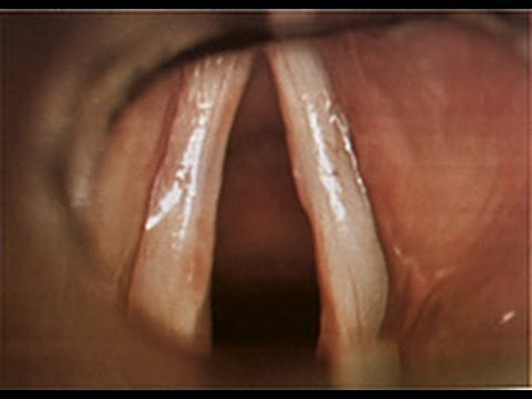Voice Disorder-Vocal Cord Nodule Removal