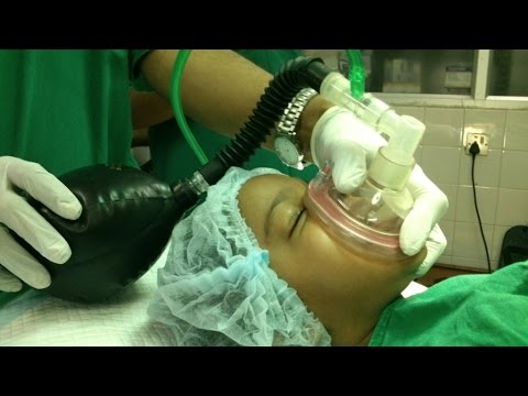 Wax Removal in A little Child-Waking After GA