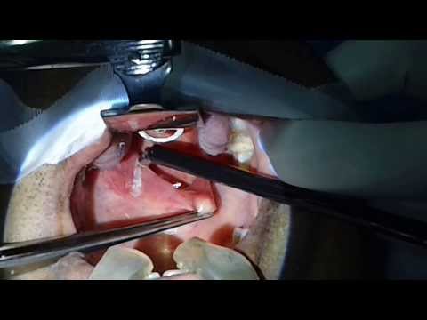 Weight Gain and Aerophagia in CPAP Users (Snoring and OSA)