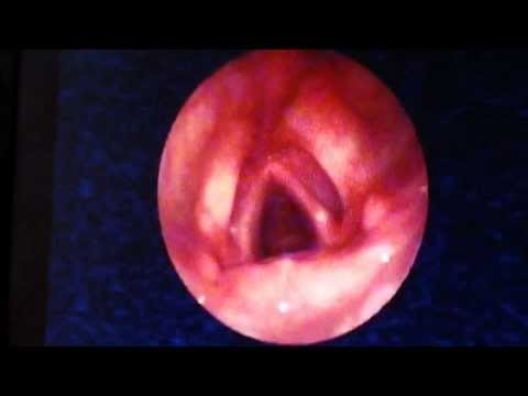 What Causes Snoring:Find out from Sleep Endoscopy