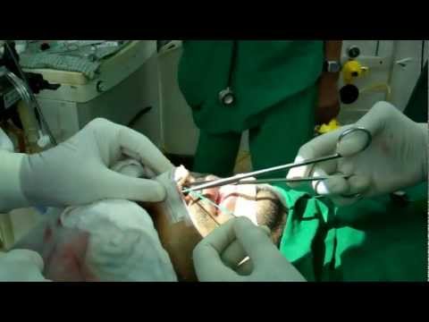 Where to find Affordable Rhinoplasty In India?