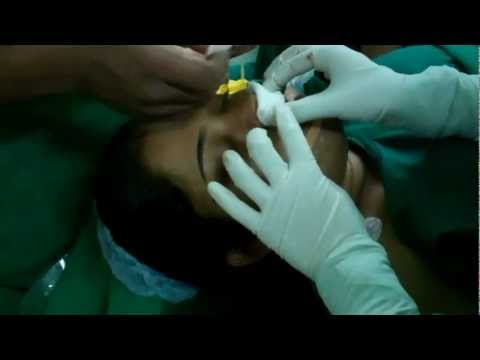 Why She Needs Septoplasty?