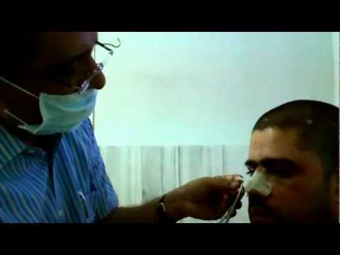 Zaif from Zinbad had Rhinoplasty