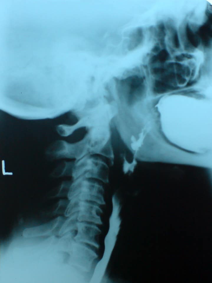 Investigating DysphagiaDifficulty in swallowing Dr Paulose